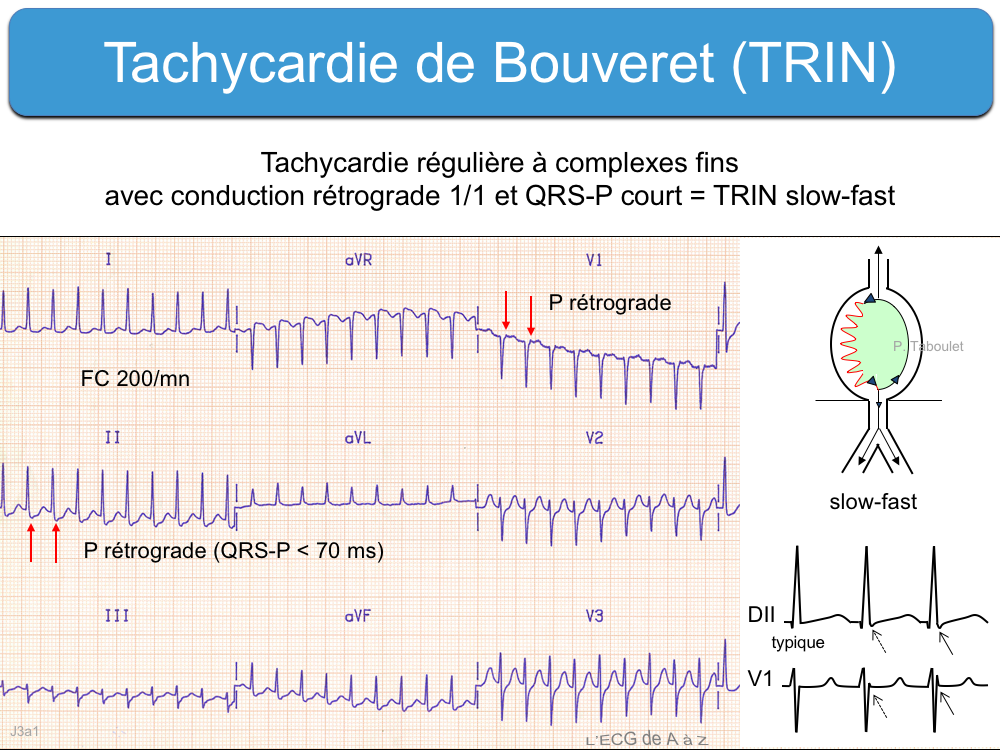 Tachycardie de Bouveret ecardiogram — free download
