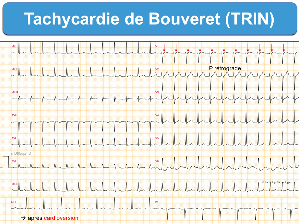Tachycardie de Bouveret ecardiogram — free download