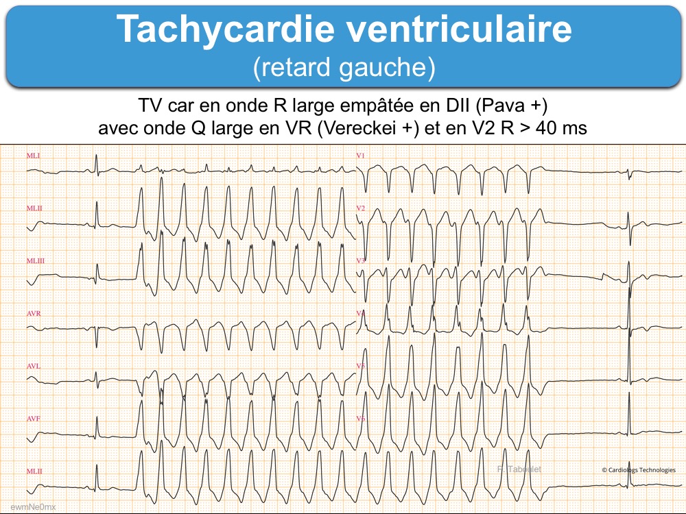 Arythmie Ventriculaire Page 10 Sur 11 E cardiogram arythmie-ventriculaire-page-10-sur-11-e-cardiogram