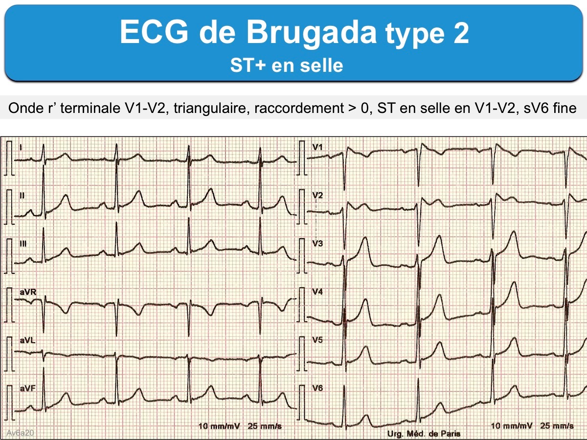 ECG Brugada.
