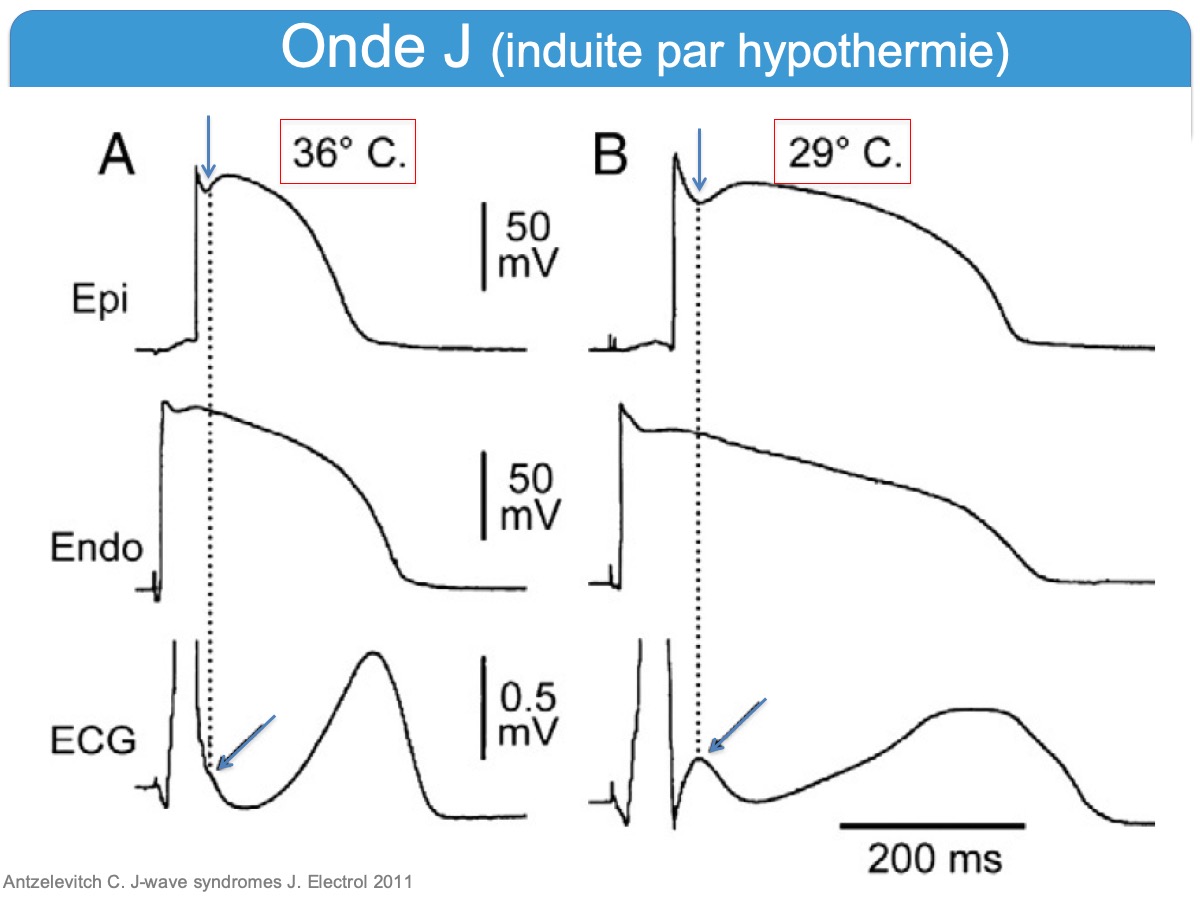 Onde J E Cardiogram Onde J E Cardiogram