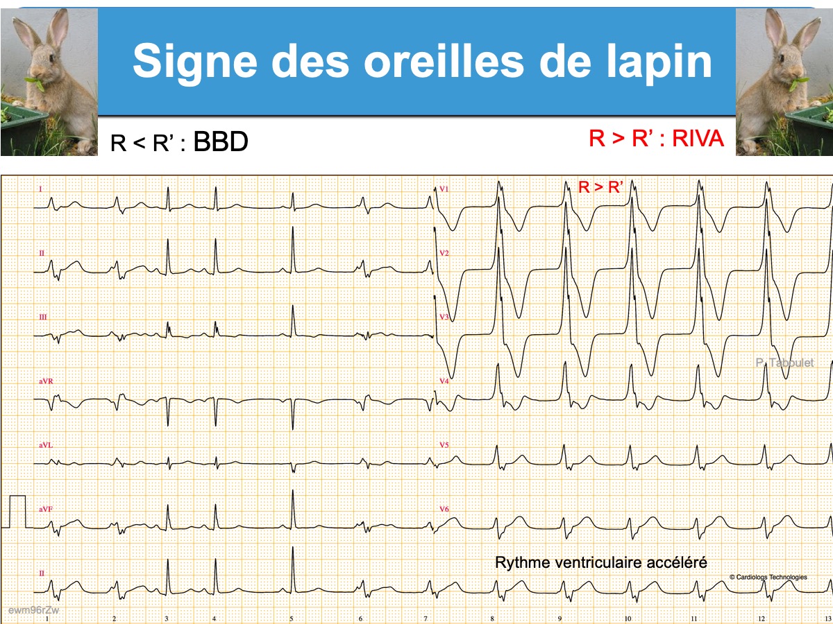 Signe des oreilles de lapin : e-cardiogram