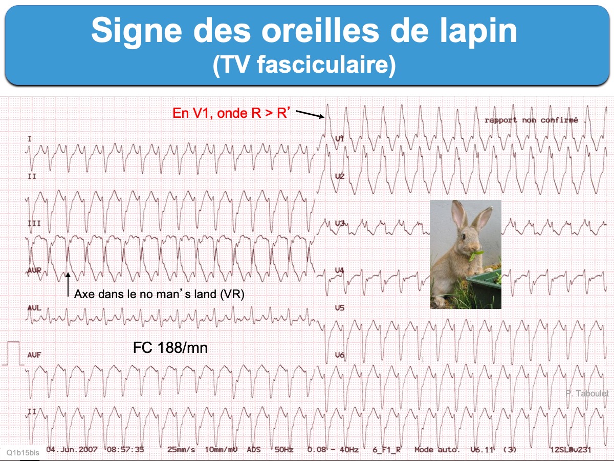 Signe des oreilles de lapin : e-cardiogram