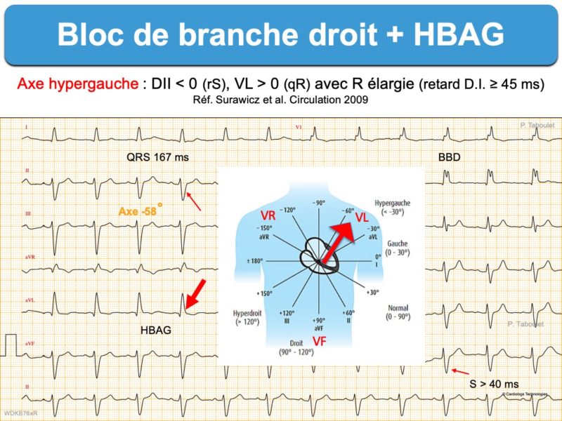 Bloc Fasciculaire Ant rieur Gauche E cardiogram bloc-fasciculaire-ant-rieur-gauche-e-cardiogram