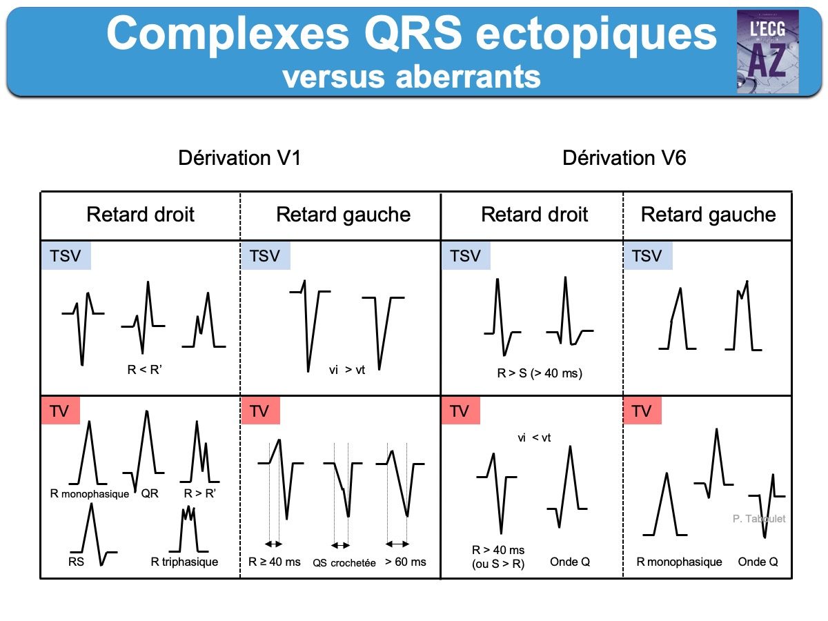 Qrs на экг что это