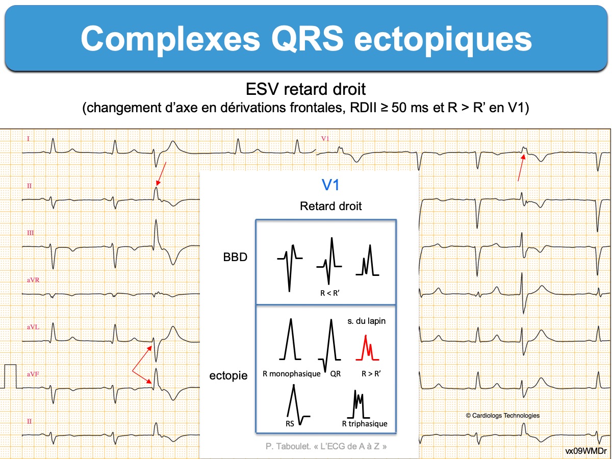 Комплекс блокада. М образный комплекс QRS В v3. М образный комплекс QRS на ЭКГ. М образный комплекс QRS блокада. Комплекс QRS В AVL.