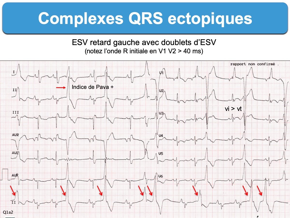 Qrs на экг что это. Расширение комплекса QRS на ЭКГ. Расширенный QRS на ЭКГ. Расширенный комплекс QRS на ЭКГ. Изменения комплекса QRS на ЭКГ.