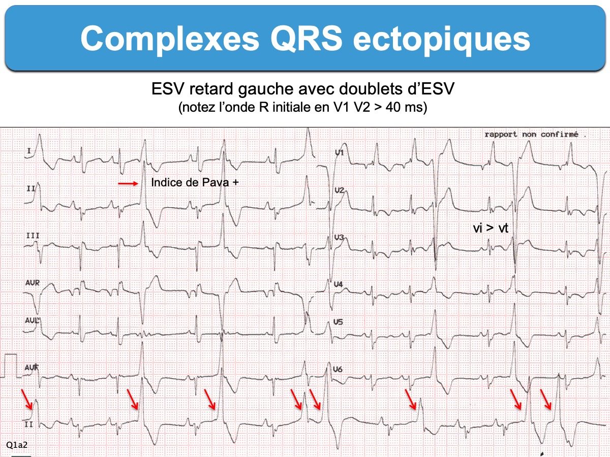 Qrs на экг что это