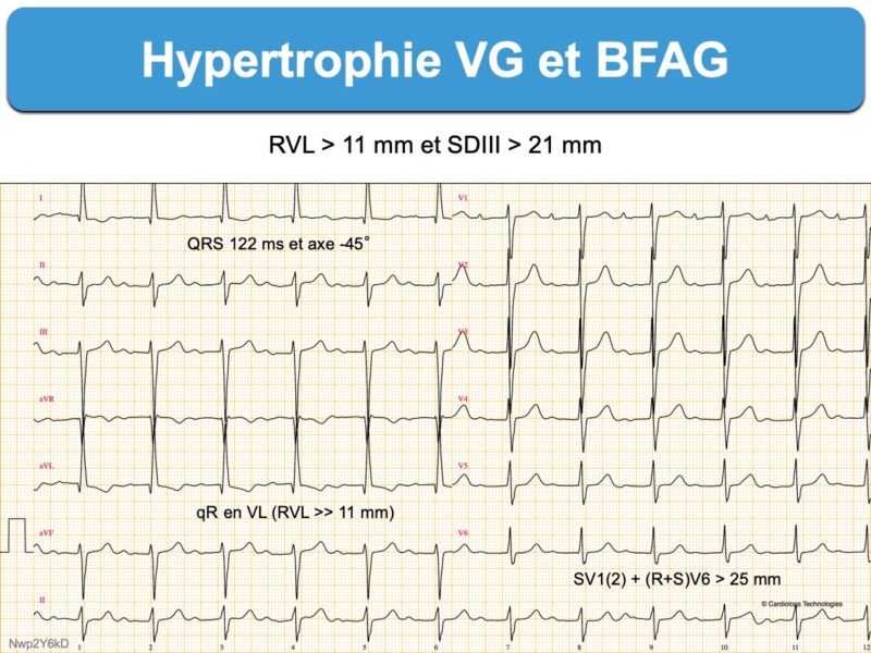 bloc-fasciculaire-ant-rieur-gauche-e-cardiogram