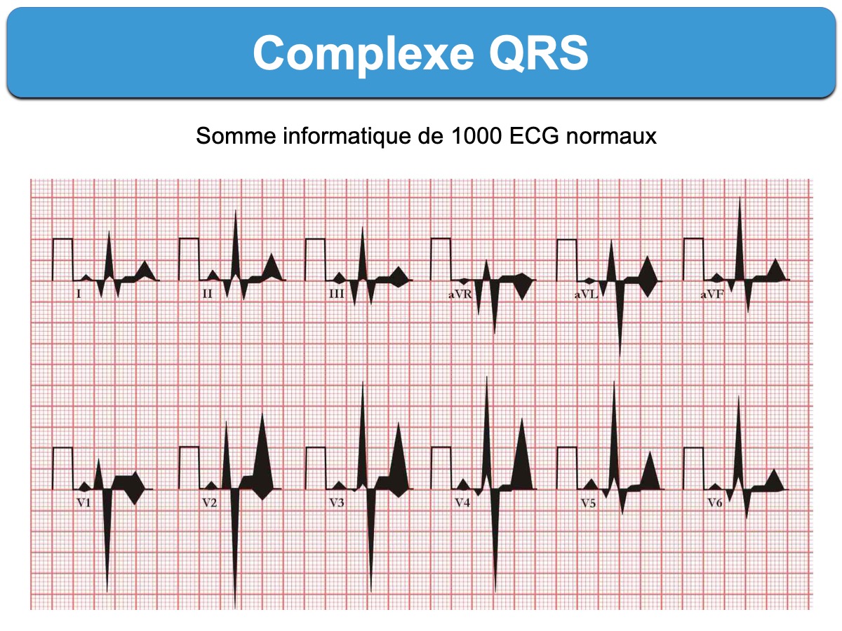 Complexe QRS : e-cardiogram