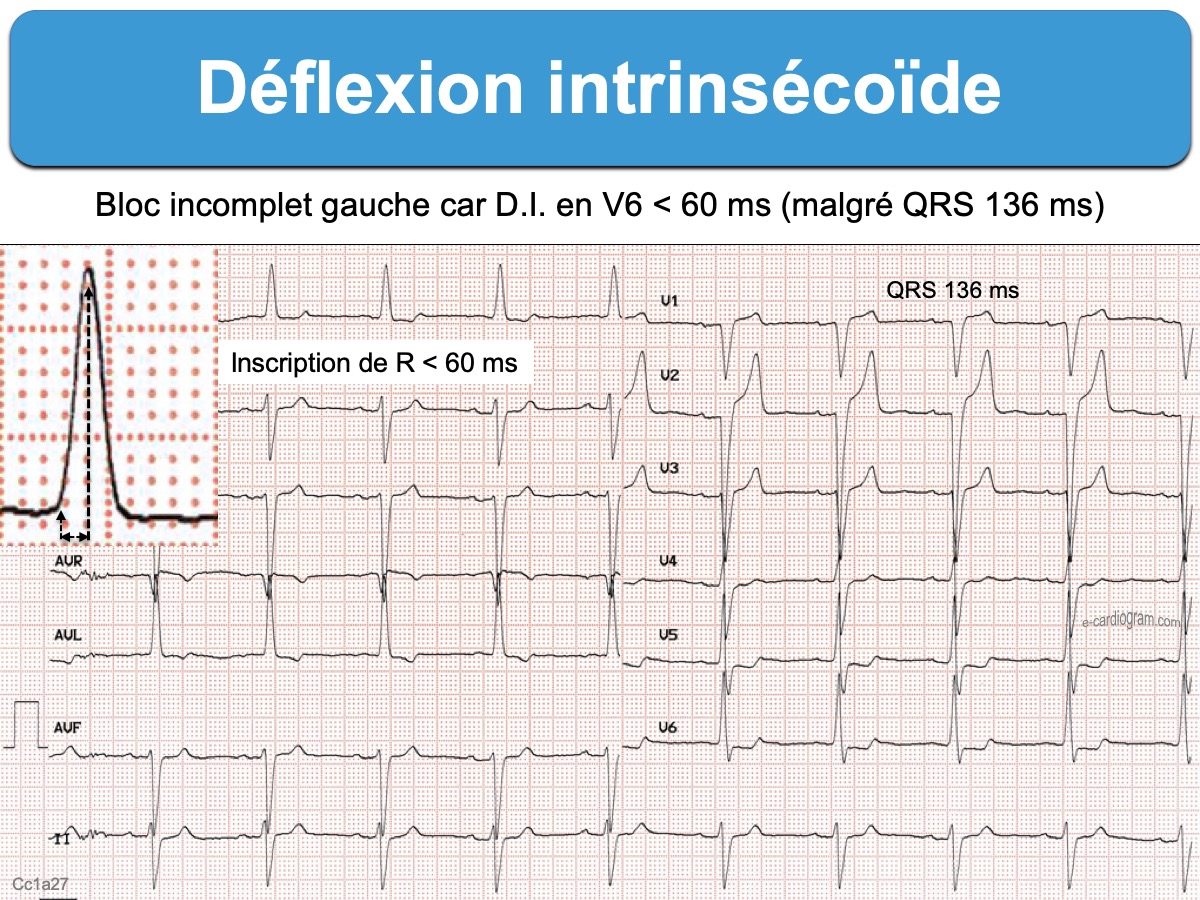 Deflexion Intrinsecoide E Cardiogram