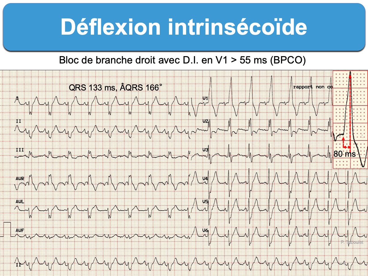 Deflexion Intrinsecoide E Cardiogram