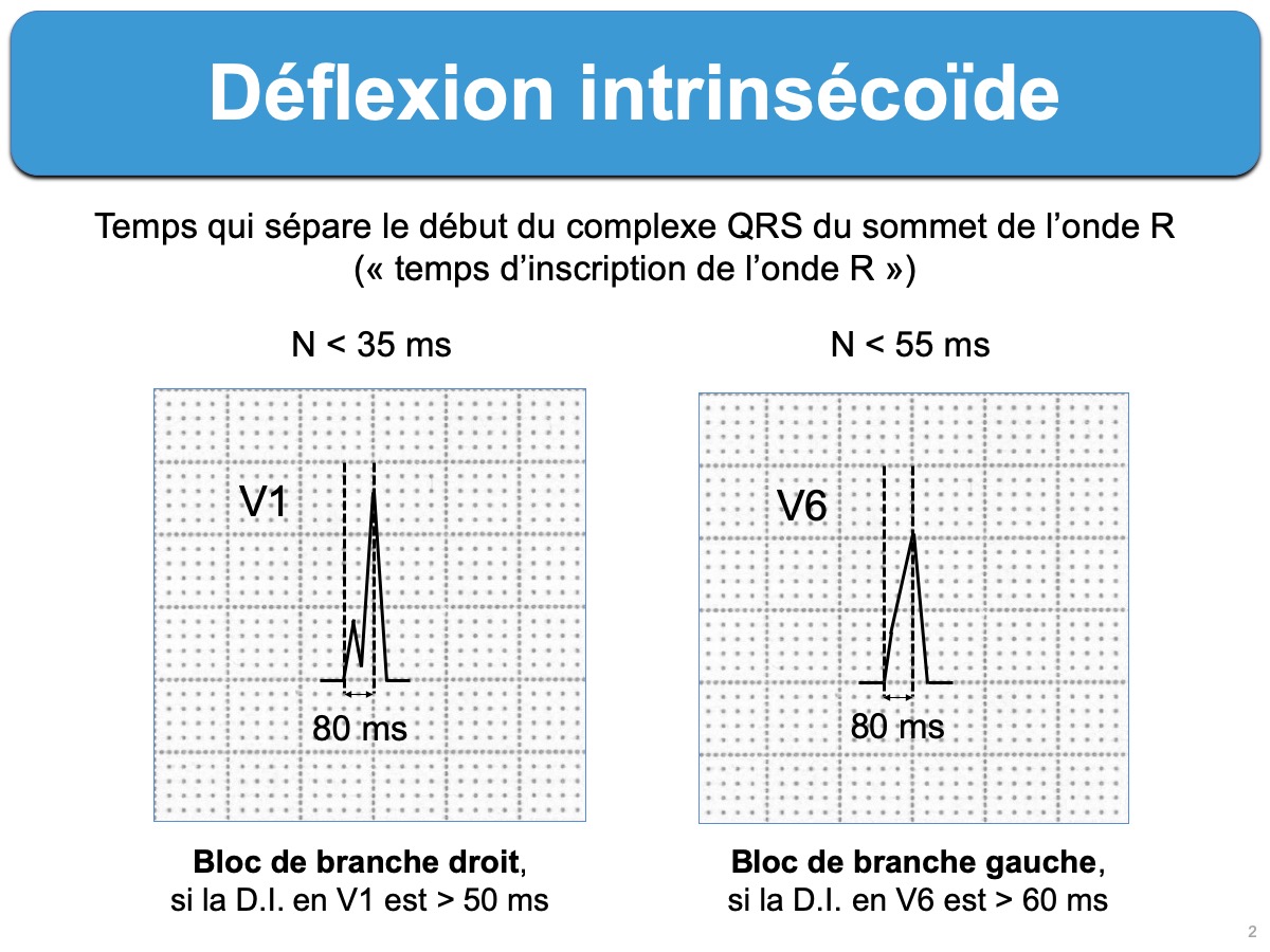 Deflexion Intrinsecoide E Cardiogram