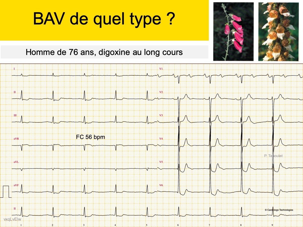 Tachycardie de Bouveret ecardiogram — free download
