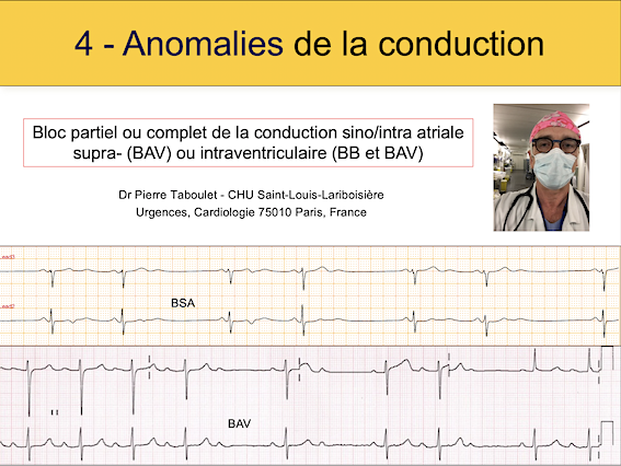 Cours 4. Anomalies de la conduction intracardiaque