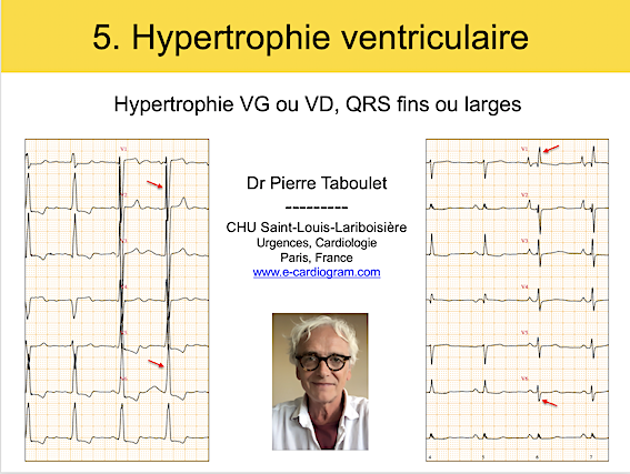 Cours 5. Hypertrophie ventriculaire gauche ou droite