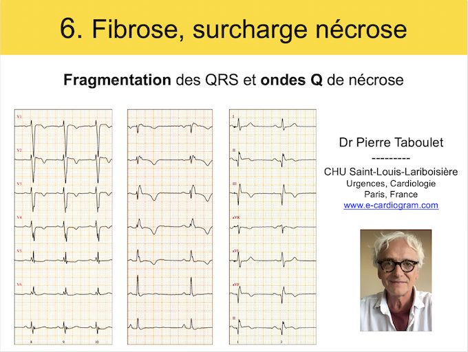 Cours 6. Fibrose, surcharge, nécrose. QRS fragments, ondes Q