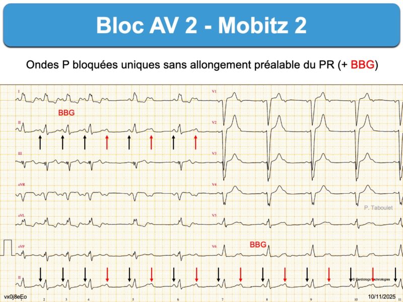 bloc-av-2e-degr-c-mobitz-2-e-cardiogram
