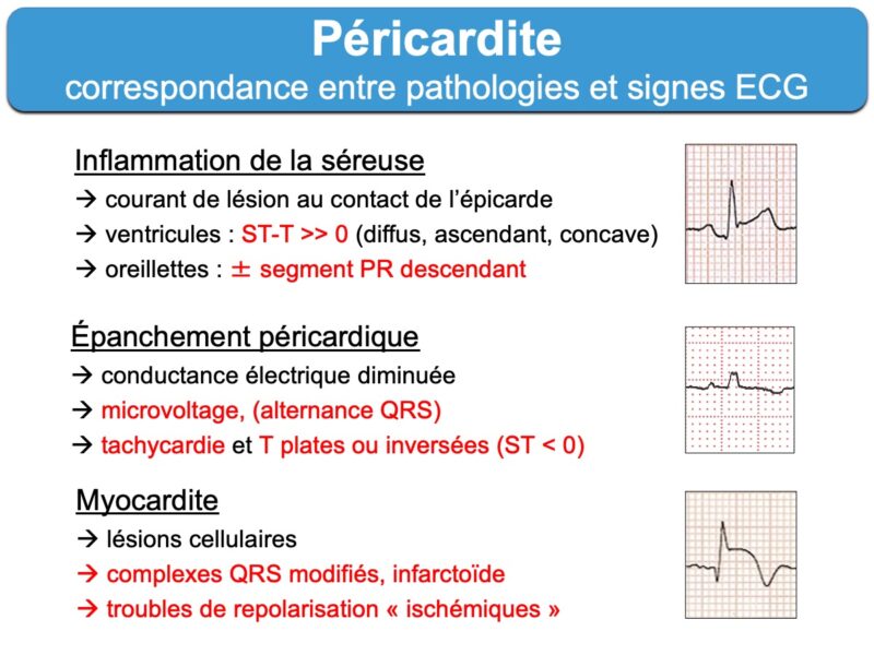 p-ricardite-aigu-1-typique-e-cardiogram