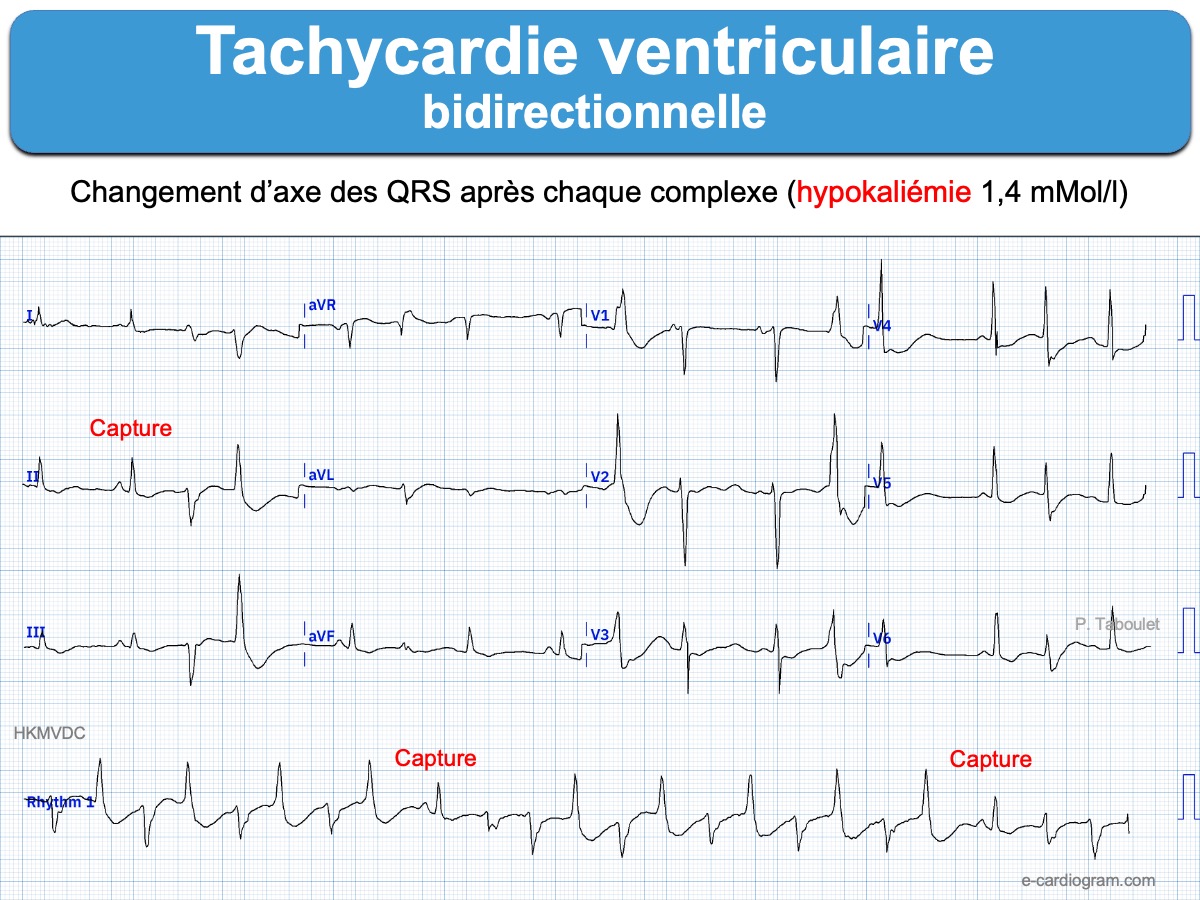 TV 1a Tachycardies Ventriculaires E cardiogram