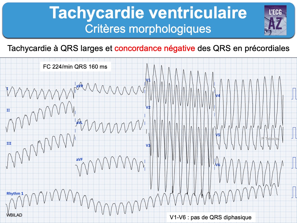 TV 1a Tachycardies Ventriculaires E cardiogram