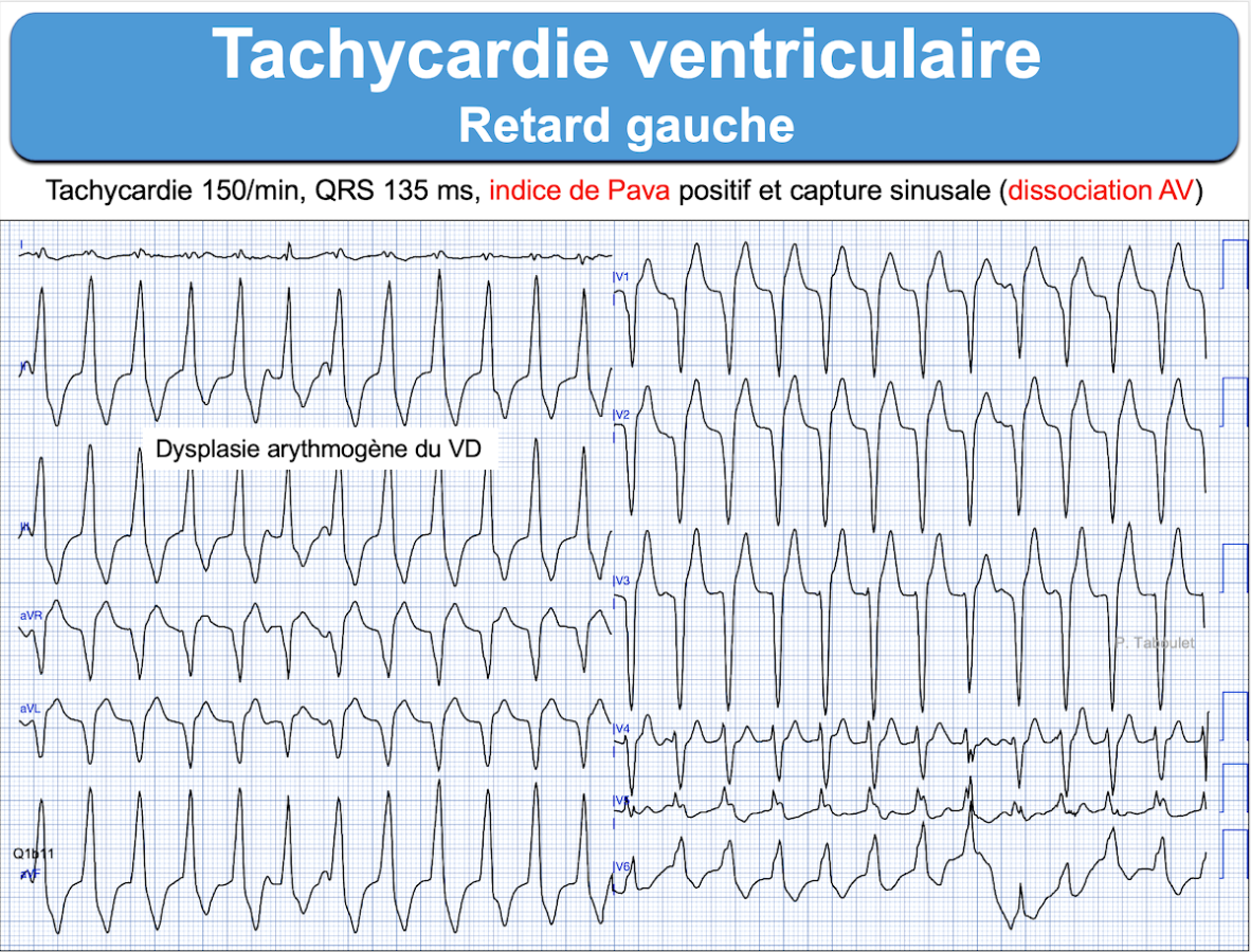Tachycardies R guli res QRS Larges TSV Ou TV E cardiogram