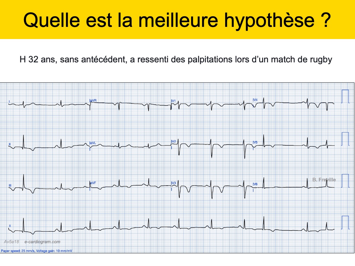 Arythmie ventriculaire : e-cardiogram